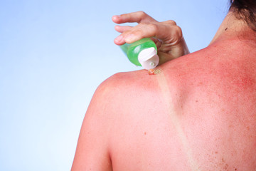 Woman applying Aloe Vera gel on her sunburned shoulder
