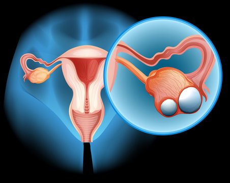 Ovarian cancer in human