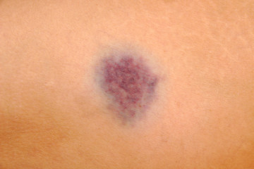 Close up of bruise on wounded woman leg skin. Gender violence