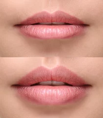 Fotobehang Sexy plump lips after filler injection © Valentina R.