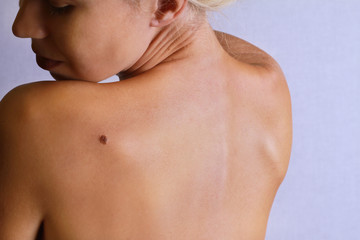 Young woman lookimg at birthmark on her back, skin. Checking benign moles - obrazy, fototapety, plakaty