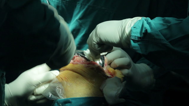 A team of surgeons using surgical instruments,cutting with scalpel,removed with scissors and third man spreading open  wound,close up,surgery.