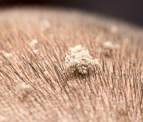 dandruff. close