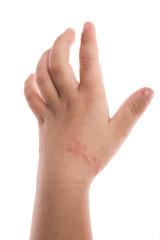 Obraz premium eczema on baby's hand