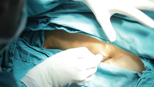 Start of operation. The surgeon performs incision in the patient's body. The surgeon cuts with a scalpel.