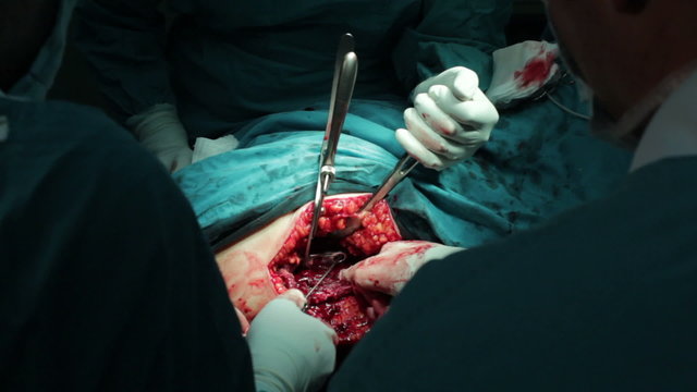 Hip implant at old man,surgeons hands,using surgical instruments,performing surgery,scene with open wound,incision close up.
