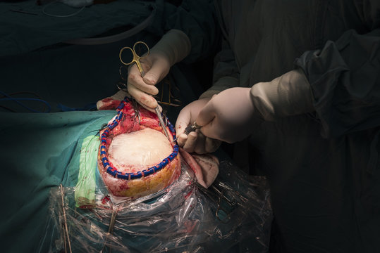 cranioplasty