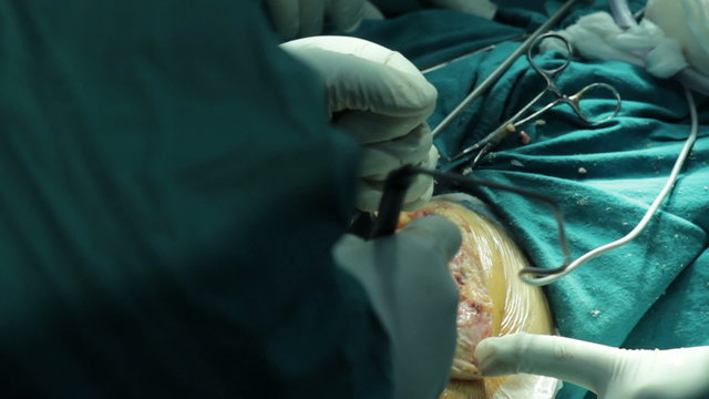 Surgeons team performing operation in hospital operating room. Knee close up. ncineration of blood vessels,stop the bleeding.