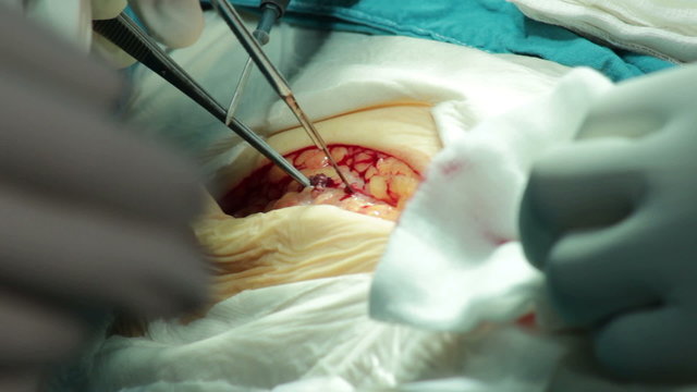 Surgeon cutting with scalpel tissue on patient's leg,performing surgical operation in operating room,extreme scene of surgery.