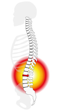 Spinal disc herniation or prolapse at a human vertebral column - profile view. Isolated vector illustration on white background.