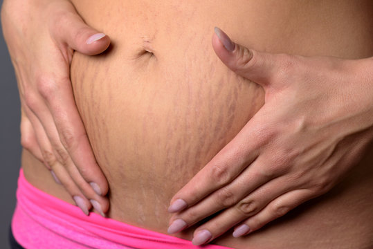 Woman showing stretch marks on her lower abdomen