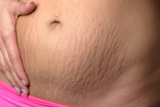 Woman displaying stretch marks after pregnancy