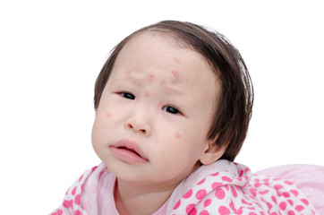 Asian girl's face with red spots due to insect bite