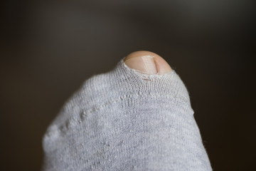 Big Toe coming through hole in torn sock