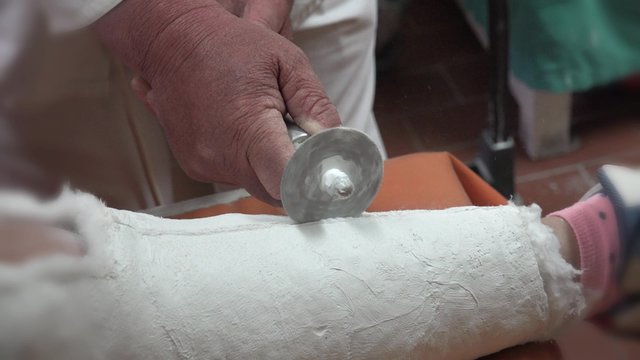 4k Extreme closeup of doctor in hospital clinic cutting and removing gypsum cast from kid&rsquo;s injured leg, side view. UHD stock footage