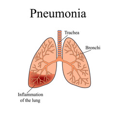 Pneumonia. The anatomical structure of the human lung. Vector