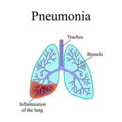 Pneumonia. The anatomical structure of the human lung. Vector