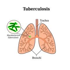 Tuberculosis. Lung disease. Tubercle bacillus. Vector