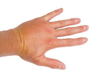 Male person showing swollen knuckles on left hand isolated on wh
