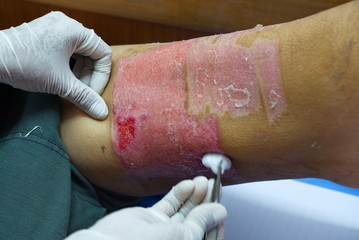granulation tissue on skin graft wound. - obrazy, fototapety, plakaty