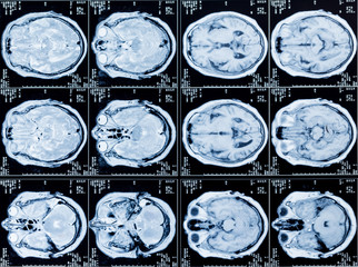 MRI Head Scan