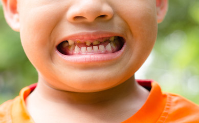 Close up child caries