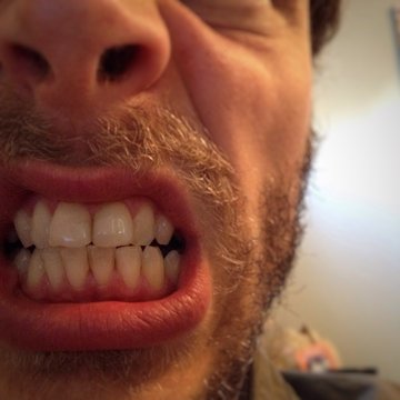 dents