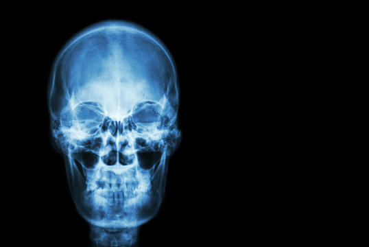 film x-ray skull of human and blank area at right side ( Medical , Science and Healthcare concept and background )