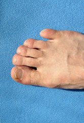 Toenail fungus with varicose veins