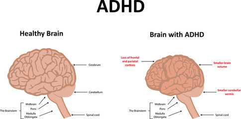 ADHD - obrazy, fototapety, plakaty