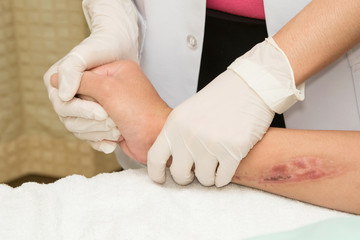 Physical therapist doing hand exercise after injury hand