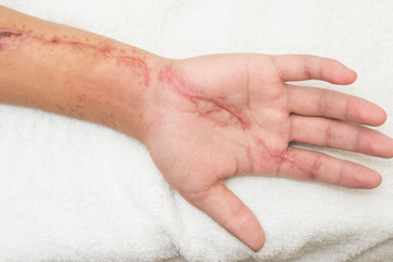 inflammation  wound in the forearm