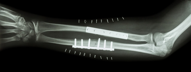Fracture both bone of forearm ( ulnar and radius ) .  It was operated and internal fixed by plate and screw