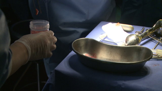 Robotic removal of the uterus