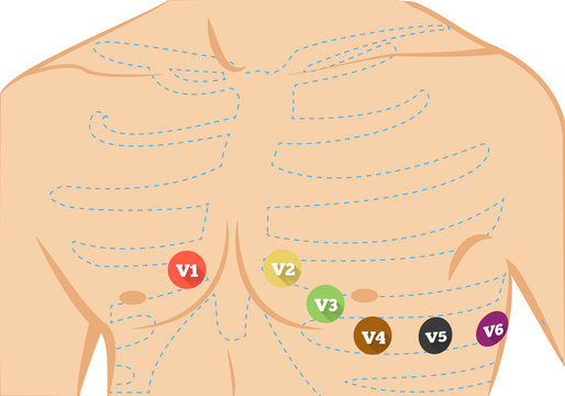 Chest ecg leads placement illustration. Six colored electrocardiography leads