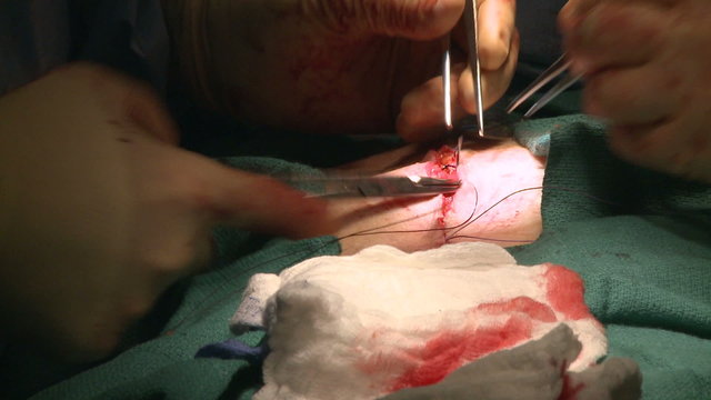 Surgeon stitching up abdomen