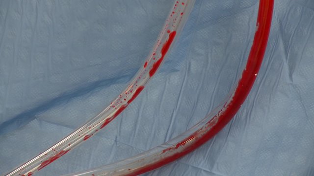 Spinal surgery blood