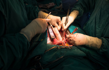 open heart surgery team