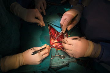 total correction tetalogy of follot