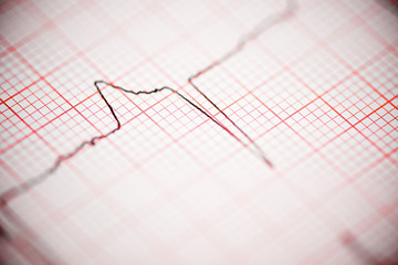 Electrocardiogram