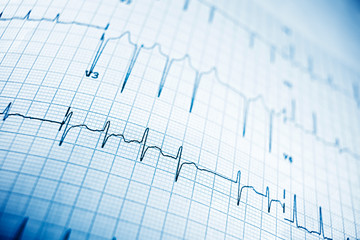 Electrocardiogram