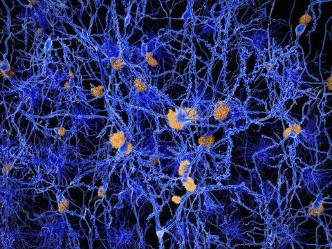 Alzheimer, neuron network with amyloid plaques