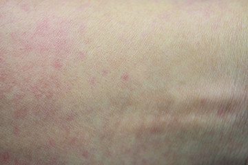 ill allergic rash dermatitis eczema skin of patient