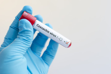Obraz premium Blood sample with Coxsackie virus positive