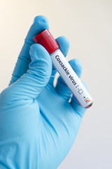 Naklejka premium Blood sample with Coxsackie virus positive
