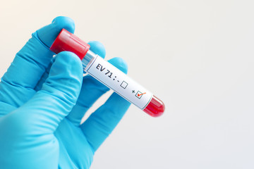 Obraz premium Enterovirus 71 (EV 71) positive