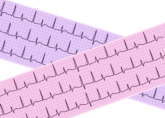 Heart analysis, electrocardiogram graph (ECG)