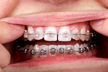 Naklejka premium Teeth with orthodontic brackets.
