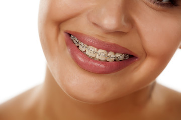 smiling female mouth with braces on her teeth