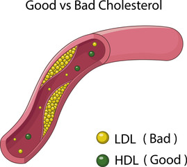 Illustration of an Artery blocked with bad cholesterol 